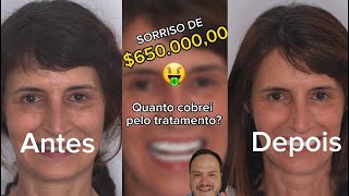 Cobrei 65000000 neste tratamento 😯 Quanto custa deixar os dentes perfeitos Dentista cobra caro [upl. by Meeharbi]