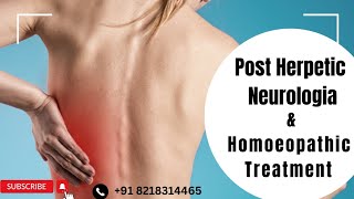 PHN  Post Herpetic Neurologia  Homoeopathic Treatment [upl. by Irah]