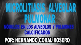 MICROLITIASIS ALVEOLAR PULMONAR  NÓDULOS EN LOS ALVEOLOS Y PULMONES CALCIFICADOS [upl. by Etirugram]