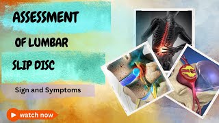 Assessment of Acute Lumbar Slip Disc without MRI Sign and Symptoms you must know [upl. by Aurelia269]