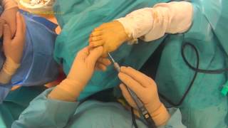 Hallux Valgus en chirurgie Mini Invasive Percutanée [upl. by Aisyle]