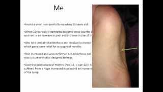 Ledderhose disease my experience and treatments [upl. by Sidoon229]