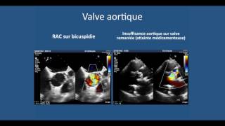 Echographie cardiaque transthoracique lessentiel a comprendre pour liECN [upl. by Riker]