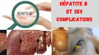 Lhépatite B Tout savoir sur le virus de lhépatite B ses complications et comment léviter [upl. by Ogeid]