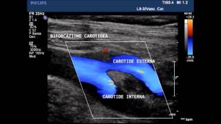 carotidi [upl. by Hadley]