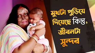 পোড়া মুখ দেখেও ও আমাকে বিয়ে করলো । Acid attack survivor। Bengali Podcast  Bengali Documentary [upl. by Zavras456]