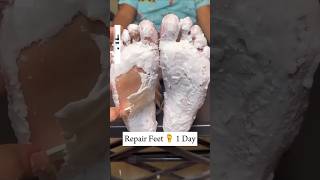 Repair cracked heels in just one daysviralvideo shorts crackedheels [upl. by Tennos]