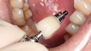 Full Contour Zirconia Implant Crown Insert [upl. by Aiahc11]