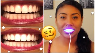 I Tried Smile Direct Teeth Whiten and THIS is What Happened 🥴 thorough review w pics [upl. by Clemen]