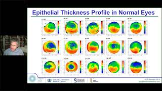 Laser Eye Surgery – Wavefront Guided Wavefront Optimised SMILE vs LASIK vs TransPRK vs ICL [upl. by Ydualc]