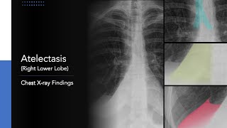 Atelectasis Right Lower Lobe Explanation of Chest Xray Findings [upl. by Irakuy]