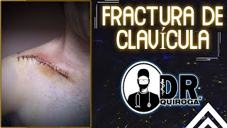 FRACTURA DE CLAVÍCULA  TRAUMATOLOGIA  Valoración clínica e imagenológica  Tipos de Fractura [upl. by Oswal]