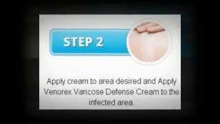 Venorex Varicose Vein Cream Reviews [upl. by Judas945]