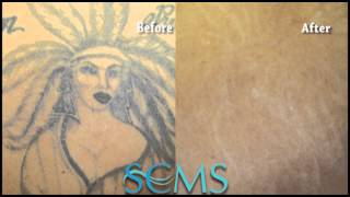 San Diego CA Laser Tattoo Removal On Neck BeforeAfter [upl. by Suaeddaht287]