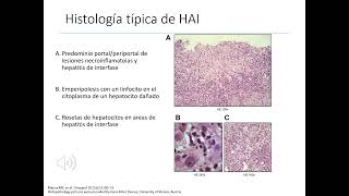 GASTROENTEROLOGÍA 7 Hepatitis crónica [upl. by Lorelei628]