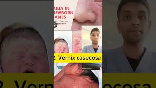 milia and vernix casecosa and lanugo shorts nursingeducation [upl. by Emorej]