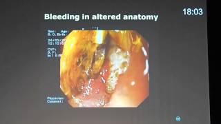 32 Device assisted enteroscopy utility in small bowel bleeding Prof Lars Aabakken [upl. by Ernest902]