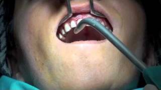 periodontal flap operasyonu [upl. by Budge]