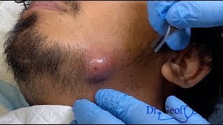 Infected Cyst Drainage on Jawline [upl. by Nahtanoj696]