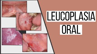 Leucoplasia oral  Odontologia Con Cri [upl. by Yeclehc]