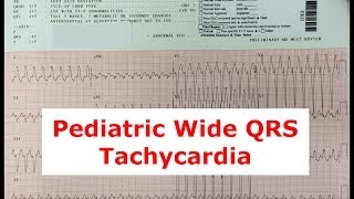 A Pediatric Patient with a Wide QRS Tachycardia [upl. by Dhaf225]