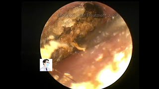 Cases of cholesteatoma treated by general anesthesia 20220709 [upl. by Wehhtam204]