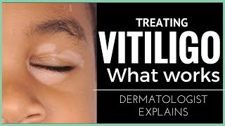 Vitiligo treatments what works [upl. by Eibocaj]