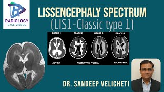 Lissencephaly SpectrumClassic Type1Sandeep VelichetIunderstanding lissencephaly microscopic level [upl. by Jackson]