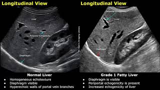 Fatty Liver Grading On Ultrasound  USG Normal Vs Abnormal Images  Grades 12 amp 3 Hepatic Steatosis [upl. by Ingeberg]