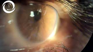 Ophthalmic Signs Syndrome [upl. by Handler]