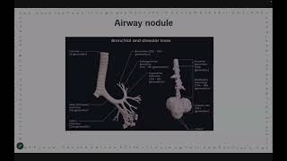 ACR Lung rads 2022 [upl. by Bobbi644]