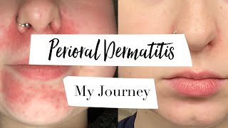 How I Treated My Perioral Dermatitis  MY JOURNEY [upl. by Feldstein]