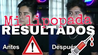 🚨ME HICE LA LIPOPADA😱Resultados Hombre🤕EXPERIENCIA [upl. by Chrisman]