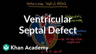 Ventricular septal defect  Circulatory System and Disease  NCLEXRN  Khan Academy [upl. by Elrebma]