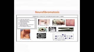 Neurofibromatosis mrcpch Clinical [upl. by Froh]