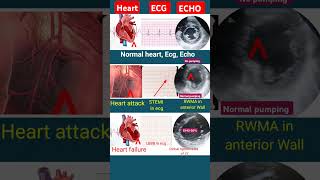 Heart attack vs Heart fail ecg  echo l ecg echo shorts [upl. by Adnoved365]