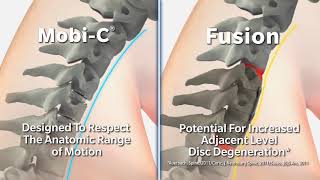 MobiC ADR vs Cervical ACDF Surgery Animation  International Spine Institute [upl. by Mcadams]