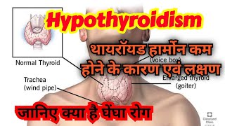 Hypothyroidism causes symptoms diagnosis amp treatment in hindi [upl. by Nylanej]