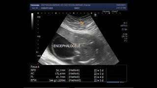 Encephalocele with a Pregnancy of about 23 weeks [upl. by Cruickshank988]