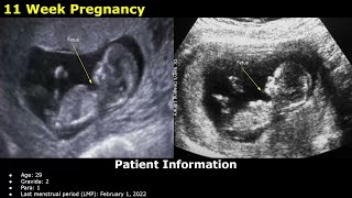 First Trimester Pregnancy Ultrasound Reporting  Obstetric USG Scan Reports  512 Weeks Fetal USG [upl. by Wilfrid]