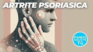 Artrite psoriasica Sintomi Diagnosi e Trattamenti Innovativi [upl. by Ennairrac]