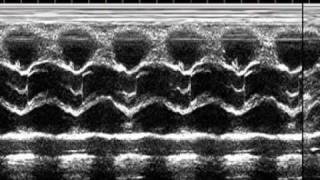 Bicuspid aortic valve [upl. by Ittocs24]