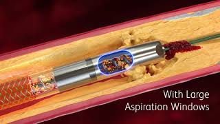 Rotarex™ Atherectomy System Now With Expanded Indications Mechanism of Action Video [upl. by Laurance]