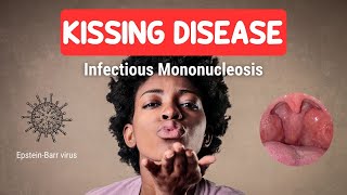 KISSING DISEASE or Infectious Mononucleosis [upl. by Yleve338]