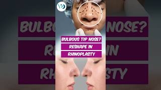 What is Bulbous Tip Nose How to Reshape in Rhinoplasty  Dr Vybhav Deraje  Aestherica Veda [upl. by Beverie]