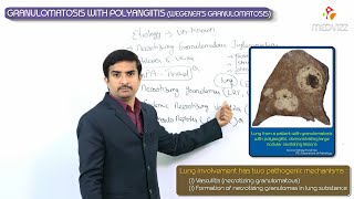 Granulomatosis with polyangiitis  Wegeners granulomatosis  Usmle step 1 vascular Pathology [upl. by Lede975]