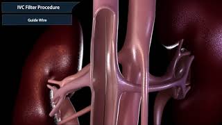 Inferior vena cava filter procedure [upl. by Aicineohp]