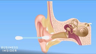 Forget QTips — Here’s How You Should Be Cleaning Your Ears [upl. by Esertal776]