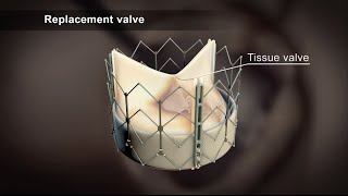 TAVI Transcatheter Aortic Valve Implantation [upl. by Enajaras109]