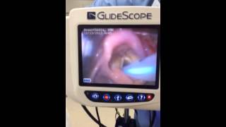 Glidescope intubation of neonate w failed NICU attempt due [upl. by Elvis]